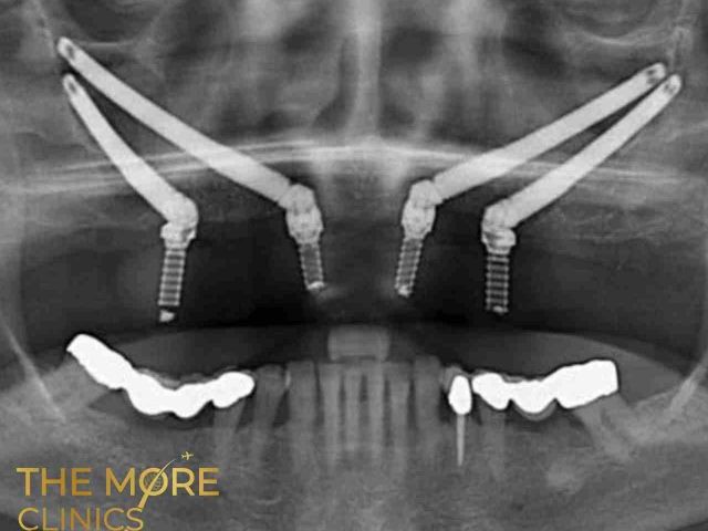 ZYGOMATIC IMPLANTS TURKEY